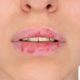 Labbra secche e apparecchio ortodontico